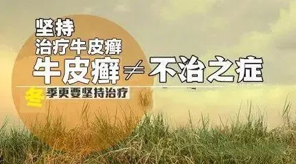 牛皮癣的治疗方法是什么